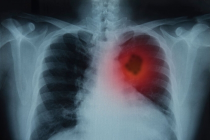 lung xray